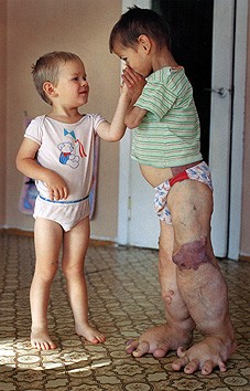 Enfant victime des radiations de Tchernobyl