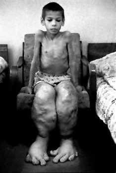 Enfant victime des radiations de Tchernobyl